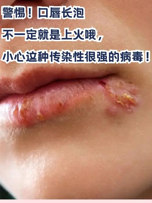 嘴唇疱疹过后为什么刺痛肿胀,疱疹快好了为啥嘴巴还是肿的?嘴唇疱疹好了后一直干裂脱皮?-第1张图片-屿企百科网 嘴唇疱疹过后为什么刺痛肿胀,疱疹快好了为啥嘴巴还是肿的?嘴唇疱疹好了后一直干裂脱皮?-第1张图片-屿企百科网