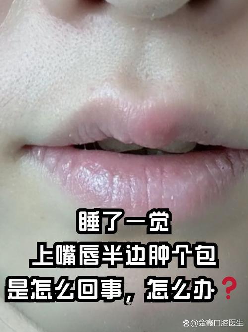 嘴唇疱疹过后为什么刺痛肿胀,疱疹快好了为啥嘴巴还是肿的?嘴唇疱疹好了后一直干裂脱皮?-第3张图片-屿企百科网 嘴唇疱疹过后为什么刺痛肿胀,疱疹快好了为啥嘴巴还是肿的?嘴唇疱疹好了后一直干裂脱皮?-第3张图片-屿企百科网