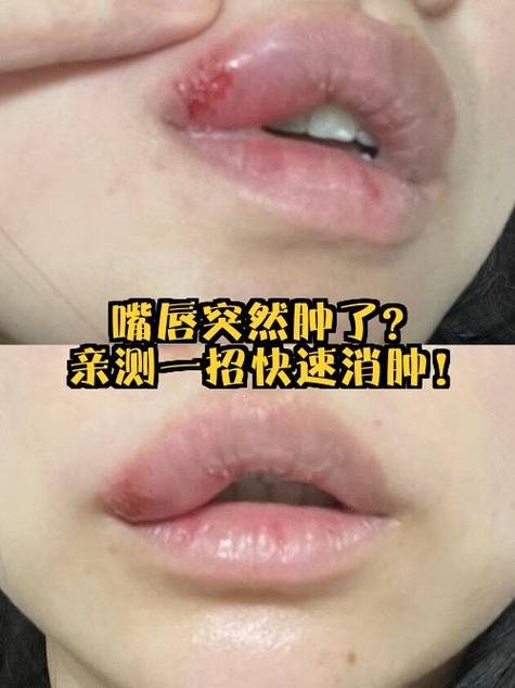 嘴唇疱疹过后为什么刺痛肿胀,疱疹快好了为啥嘴巴还是肿的?嘴唇疱疹好了后一直干裂脱皮?-第4张图片-屿企百科网 嘴唇疱疹过后为什么刺痛肿胀,疱疹快好了为啥嘴巴还是肿的?嘴唇疱疹好了后一直干裂脱皮?-第4张图片-屿企百科网