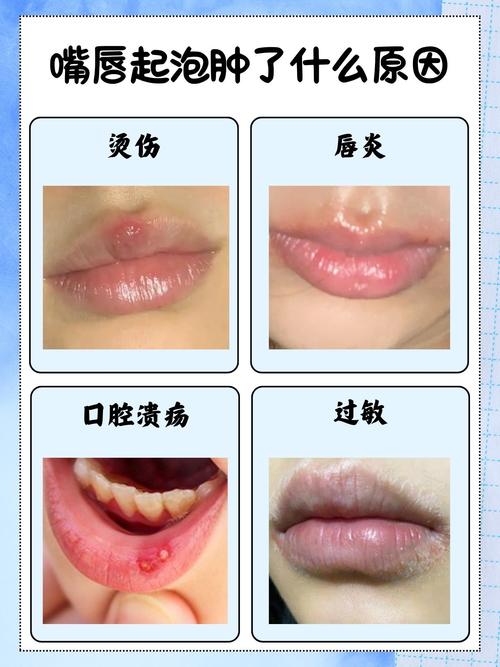 嘴唇疱疹过后为什么刺痛肿胀,疱疹快好了为啥嘴巴还是肿的?嘴唇疱疹好了后一直干裂脱皮?-第5张图片-屿企百科网 嘴唇疱疹过后为什么刺痛肿胀,疱疹快好了为啥嘴巴还是肿的?嘴唇疱疹好了后一直干裂脱皮?-第5张图片-屿企百科网