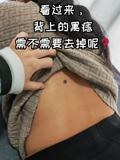 肩有痣穷一生是真的吗，肩膀有痣的是什么命运，肩部有痣好吗-第2张图片-屿企百科网