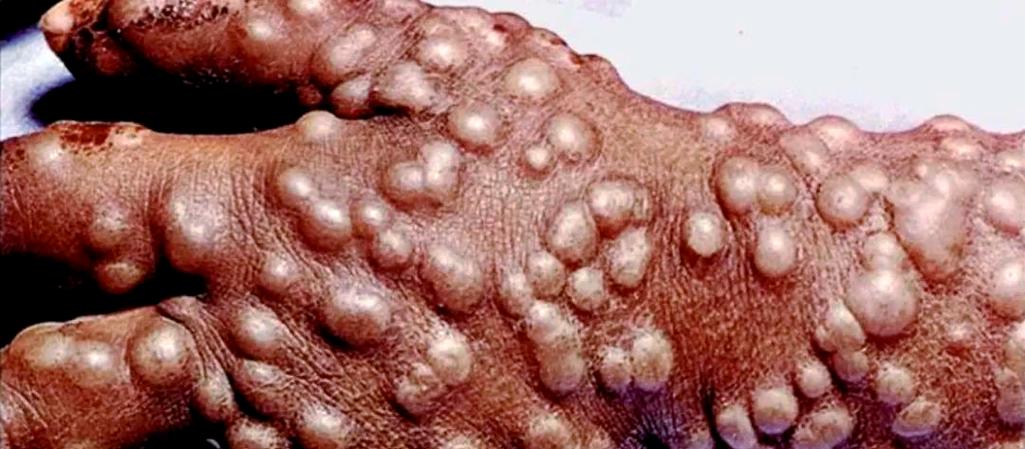 为什么天花是唯一被消灭的,天花为什么绝迹了?-第6张图片-屿企百科网 为什么天花是唯一被消灭的,天花为什么绝迹了?-第6张图片-屿企百科网